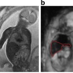 Intra-voxel incoherent motion MRI of the living human foetus: technique and test–retest repeatability
