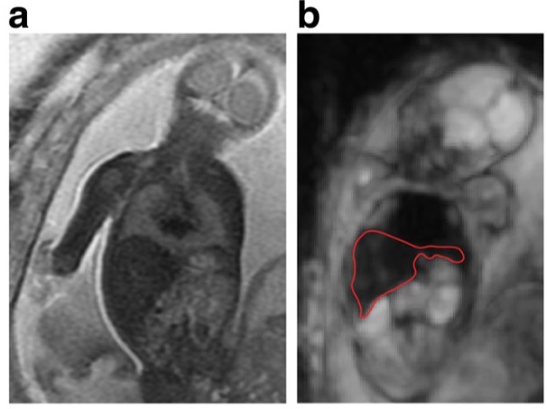 Intra-voxel incoherent motion MRI of the living human foetus: technique and test–retest repeatability