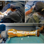 Through the HoloLens™ looking glass: augmented reality for extremity reconstruction surgery using 3D vascular models with perforating vessels