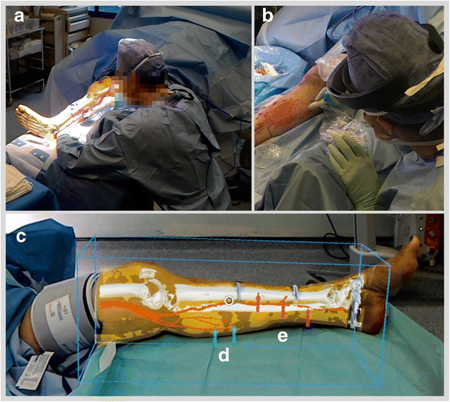 Through the HoloLens™ looking glass: augmented reality for extremity reconstruction surgery using 3D vascular models with perforating vessels